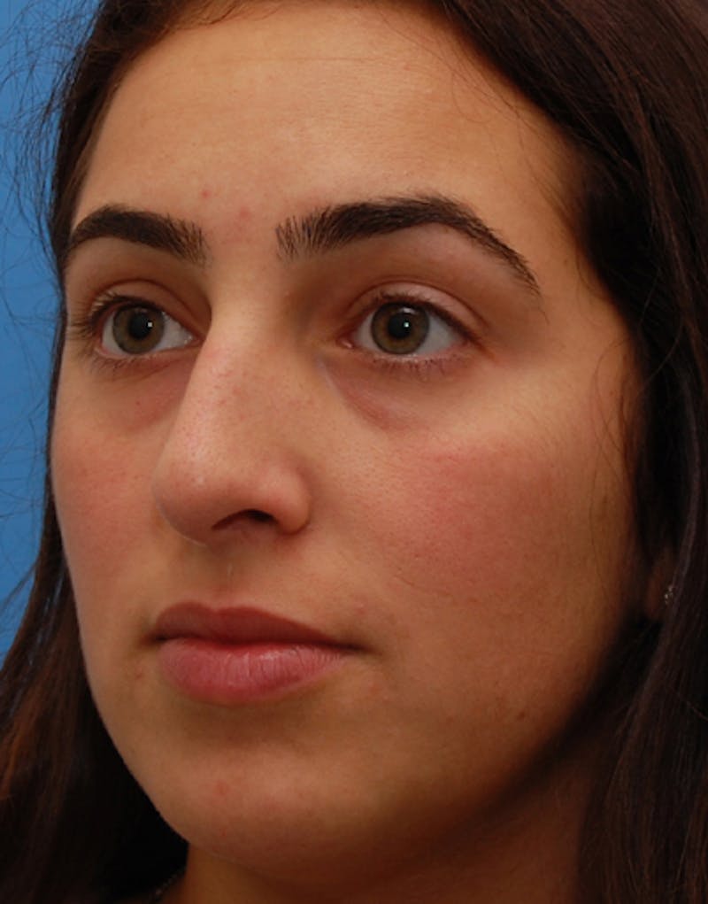 Rhinoplasty Before & After Gallery - Patient 383421 - Image 7