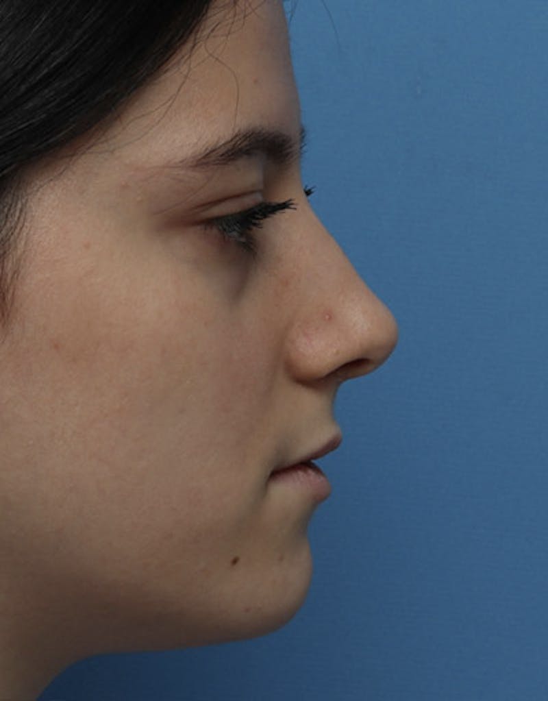 Revision Rhinoplasty Before & After Gallery - Patient 985041 - Image 1