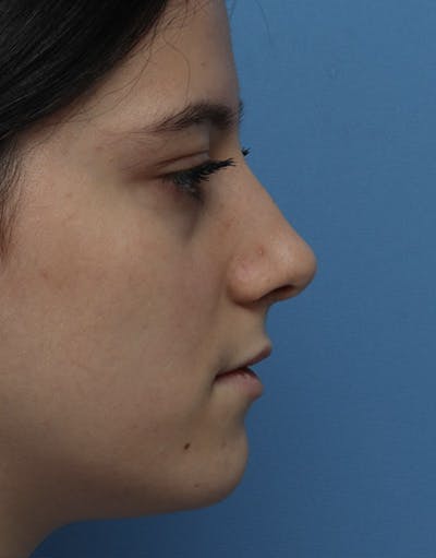 Rhinoplasty Before & After Gallery - Patient 277758 - Image 1