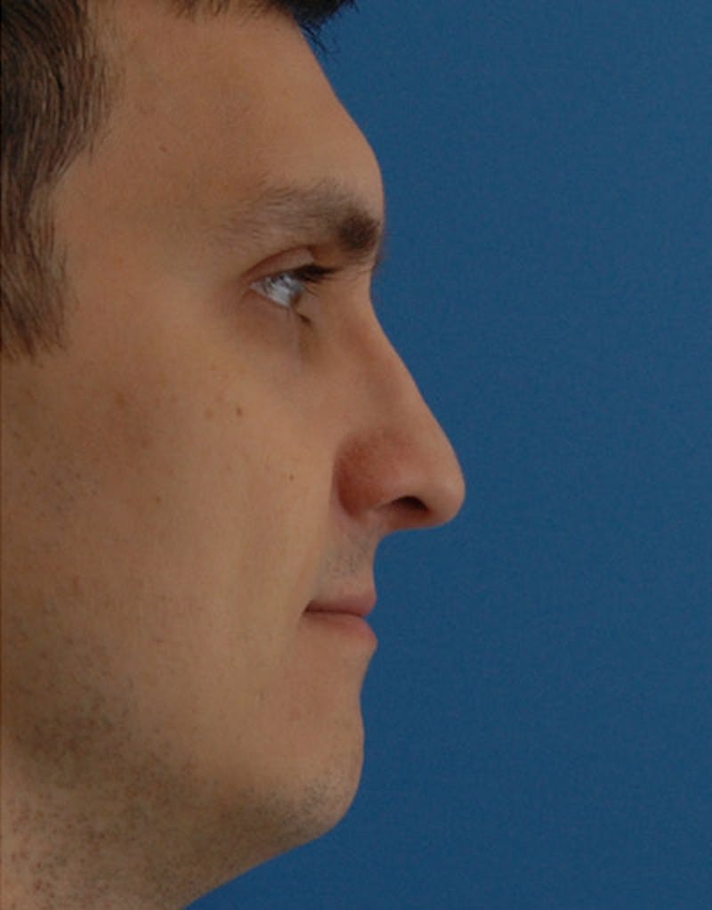 Foundation Rhinoplasty / Crooked Nose Before & After Gallery - Patient 128754 - Image 4
