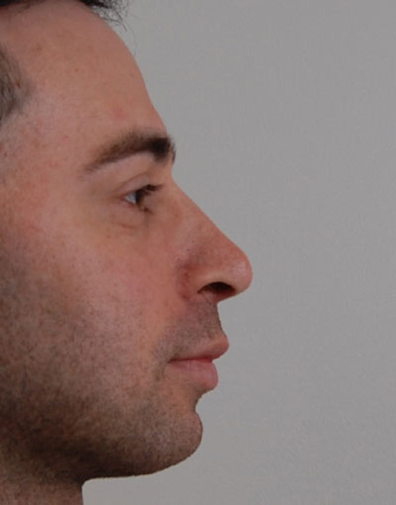 Male Rhinoplasty Before & After Gallery - Patient 123470 - Image 2