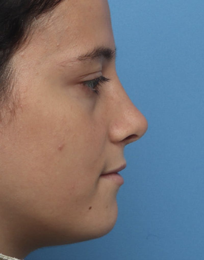 Revision Rhinoplasty Before & After Gallery - Patient 985041 - Image 2