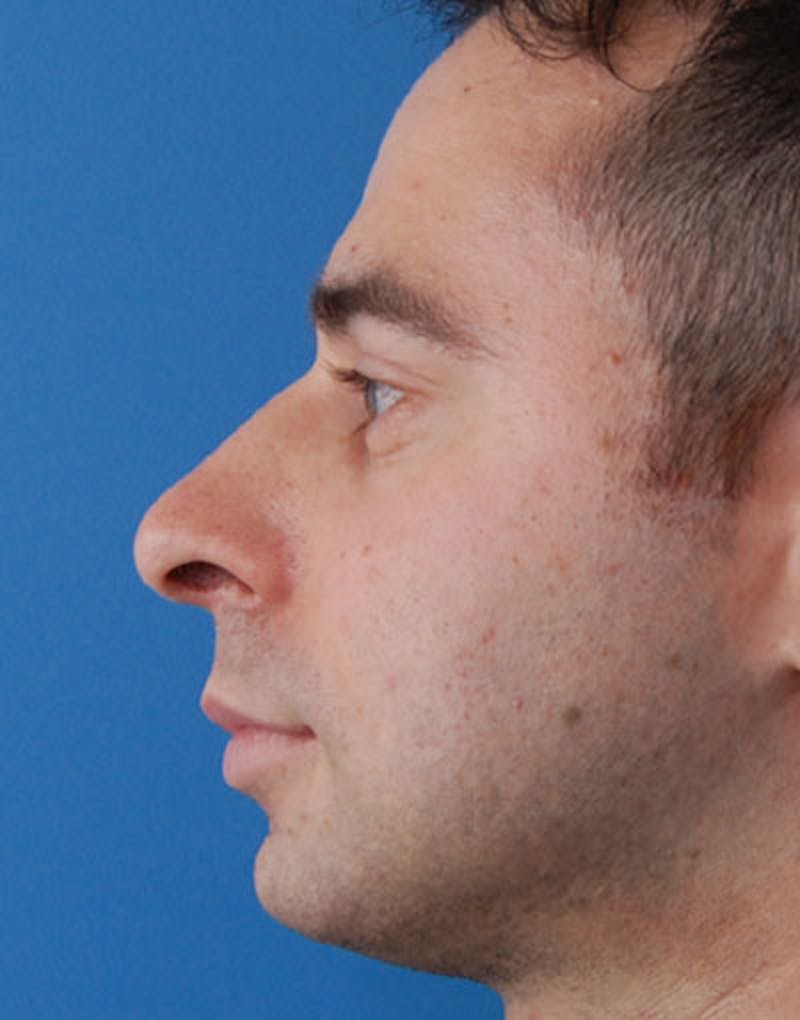 Male Rhinoplasty Before & After Gallery - Patient 123470 - Image 3
