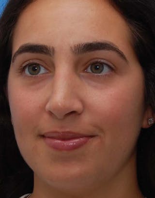 Rhinoplasty Before & After Gallery - Patient 333309 - Image 8