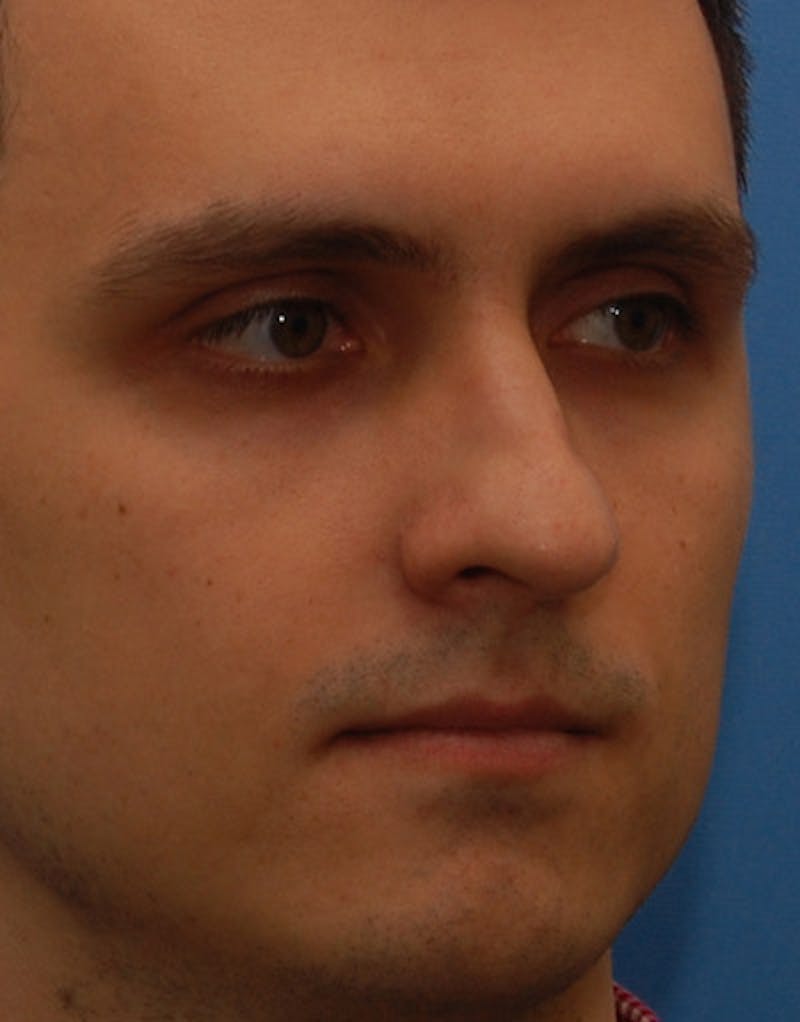 Rhinoplasty  Before & After Gallery - Patient 387643 - Image 5
