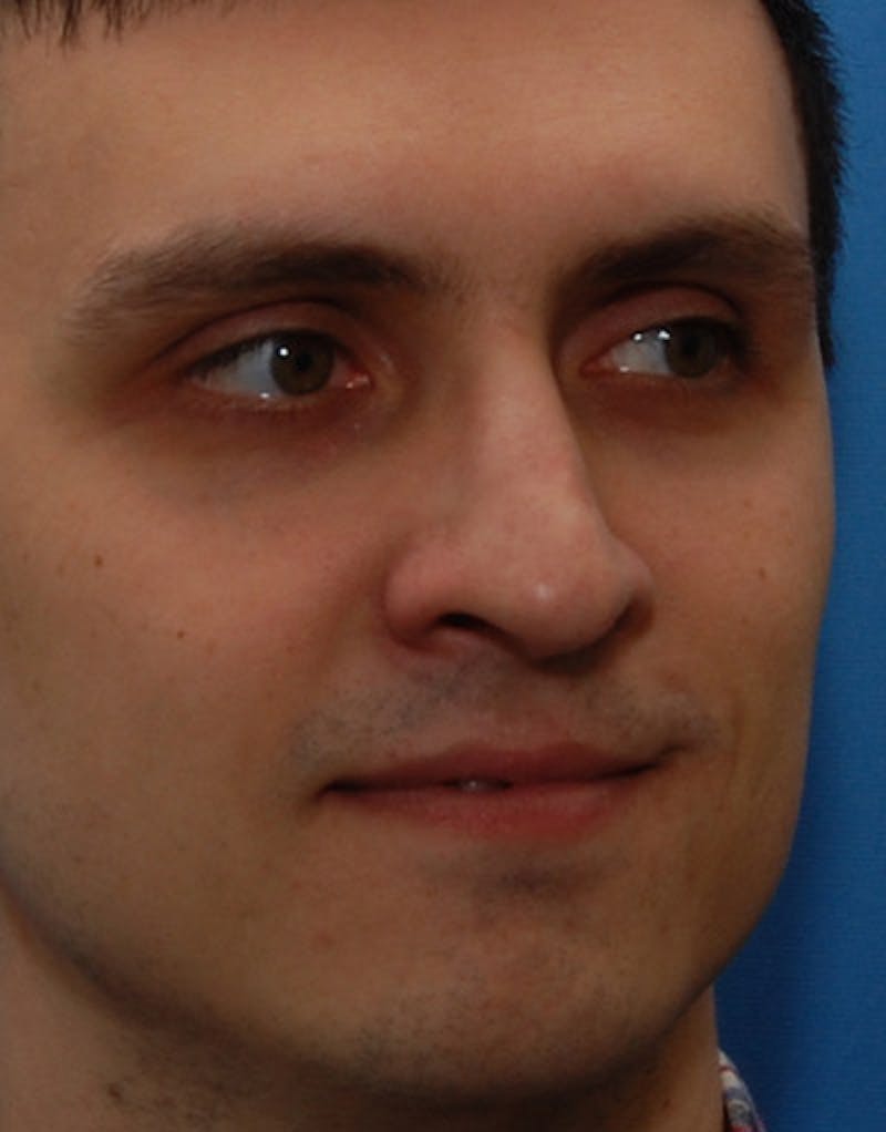 Rhinoplasty  Before & After Gallery - Patient 387643 - Image 6