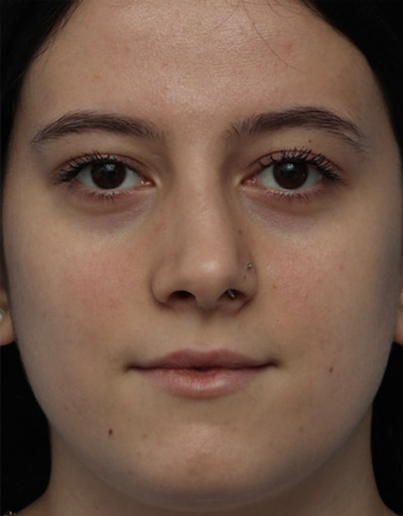 Revision Rhinoplasty Before & After Gallery - Patient 985041 - Image 3