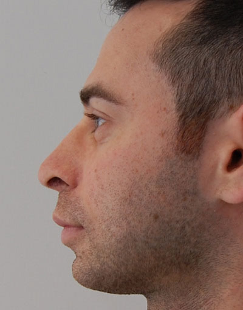 Male Rhinoplasty Before & After Gallery - Patient 123470 - Image 4