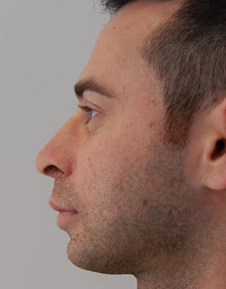 Rhinoplasty Before & After Gallery - Patient 380345 - Image 4
