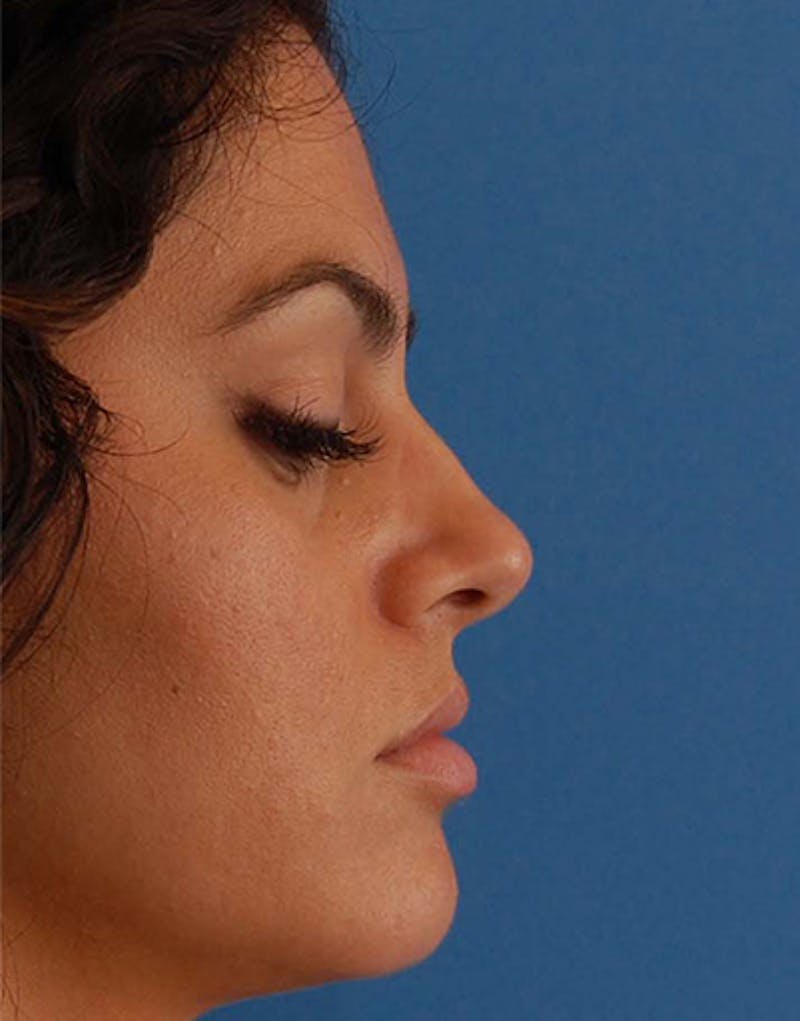 Rhinoplasty Before & After Gallery - Patient 384110 - Image 1