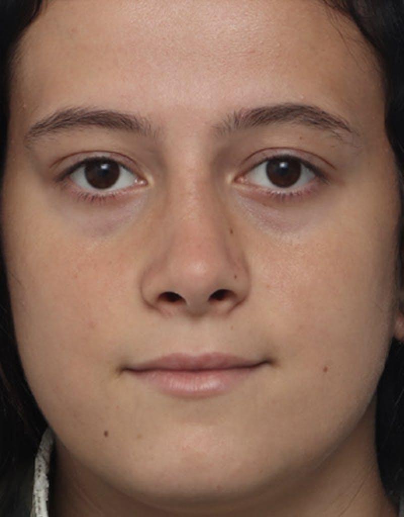 Revision Rhinoplasty Before & After Gallery - Patient 985041 - Image 4