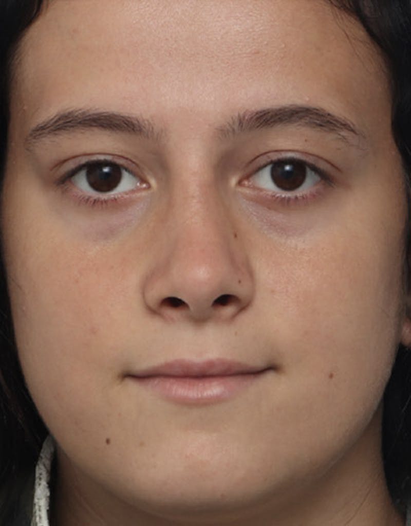 Rhinoplasty  Before & After Gallery - Patient 277758 - Image 4