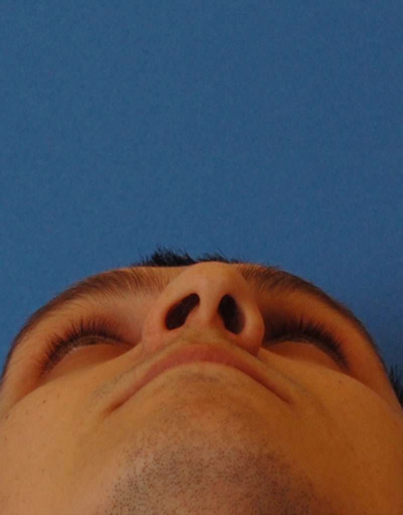 Rhinoplasty  Before & After Gallery - Patient 387643 - Image 7