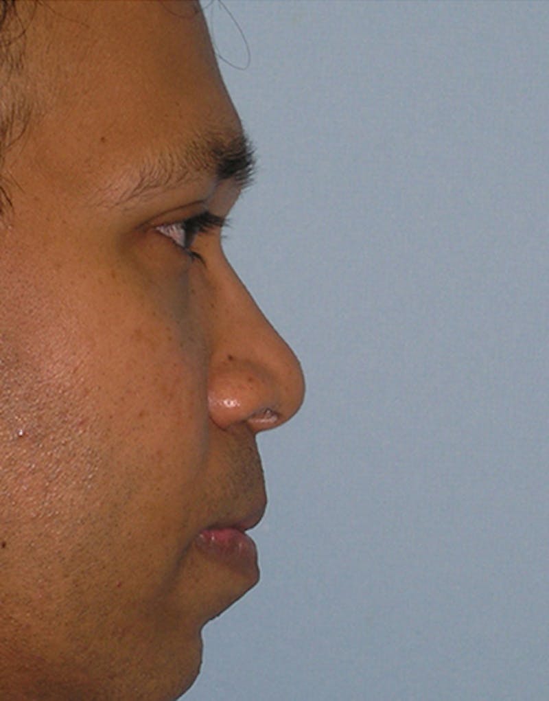 Male Rhinoplasty Before & After Gallery - Patient 389820 - Image 1