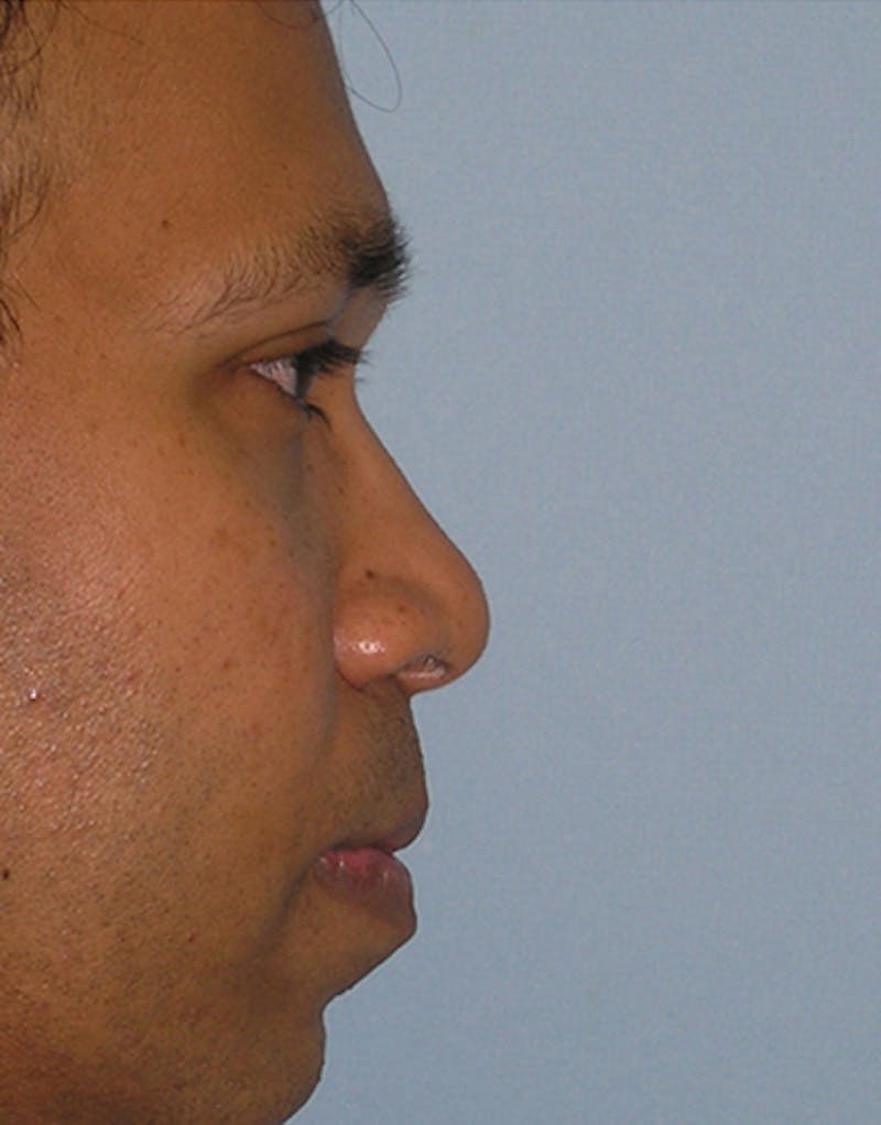 Patient Fzrk3TOVTReZVyio1iLkSA - Male Rhinoplasty Before & After Photos