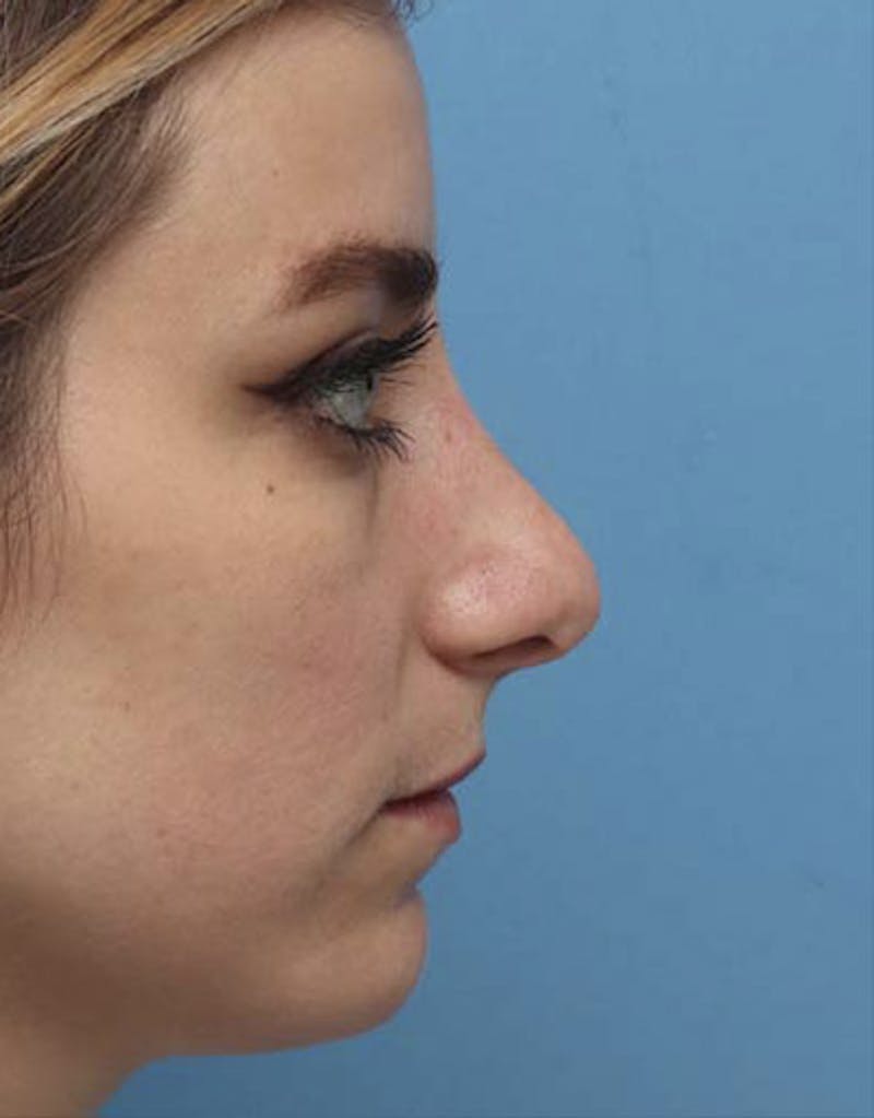 Revision Rhinoplasty Before & After Gallery - Patient 182365 - Image 1