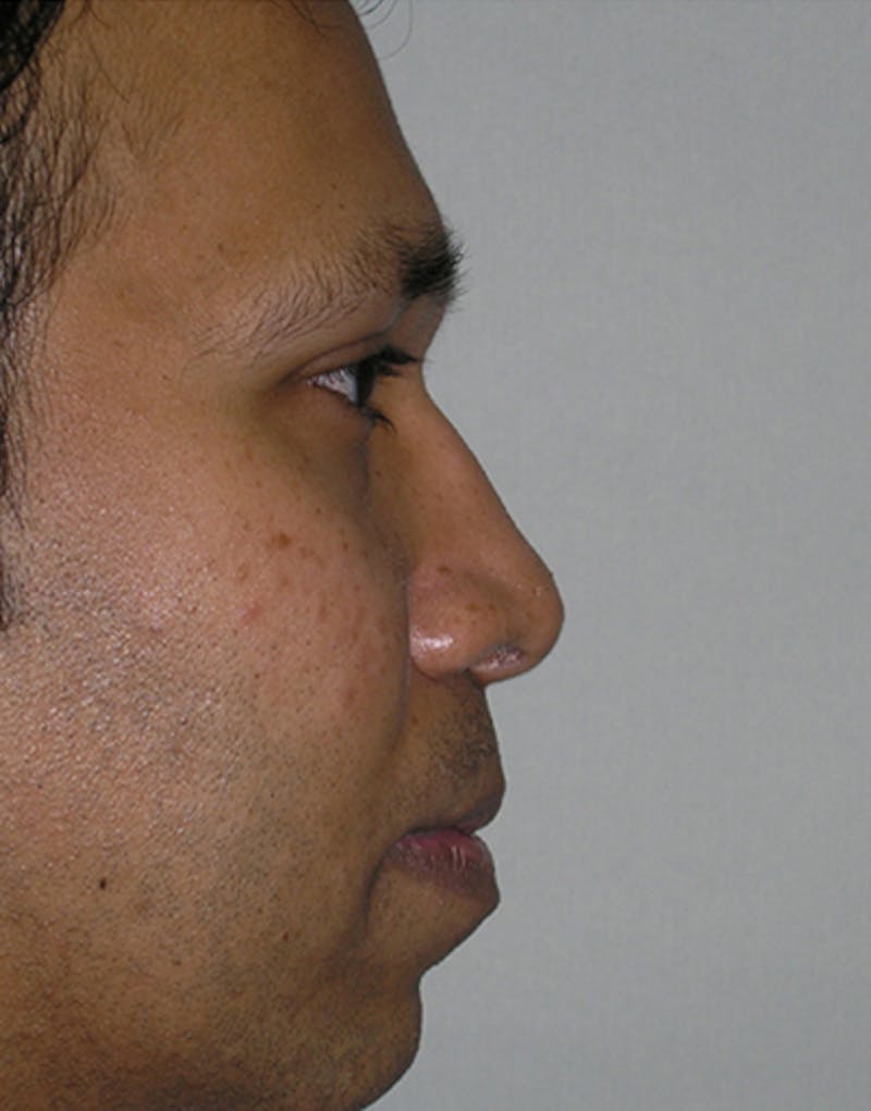 Male Rhinoplasty Before & After Gallery - Patient 389820 - Image 2