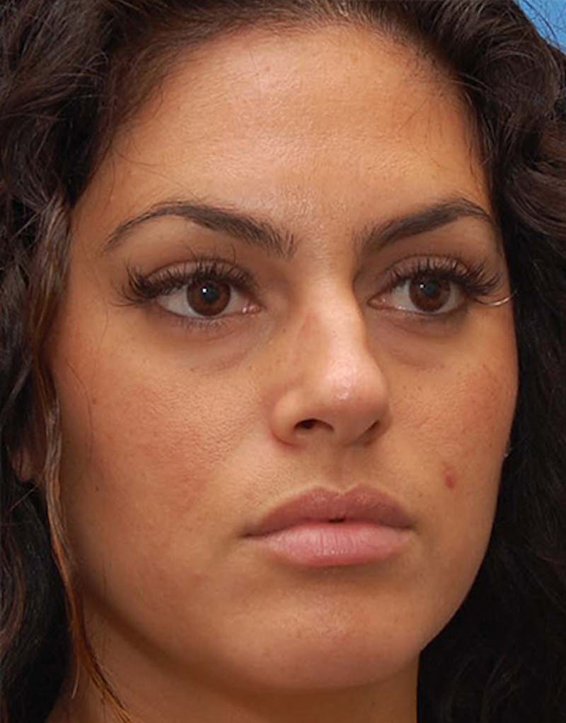 Patient OMfA6GcJROyQnaNxw2UpIg - Rhinoplasty Before & After Photos