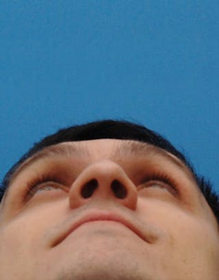 Rhinoplasty Before & After Gallery - Patient 387643 - Image 8