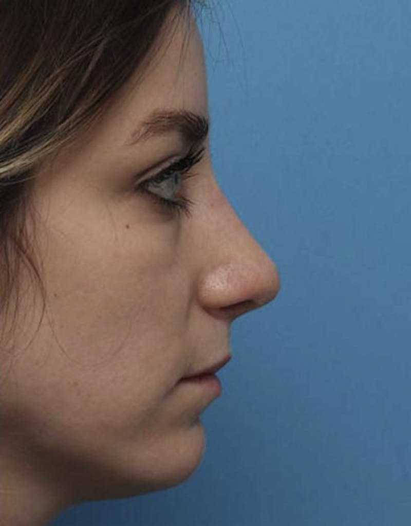 Revision Rhinoplasty Before & After Gallery - Patient 182365 - Image 2