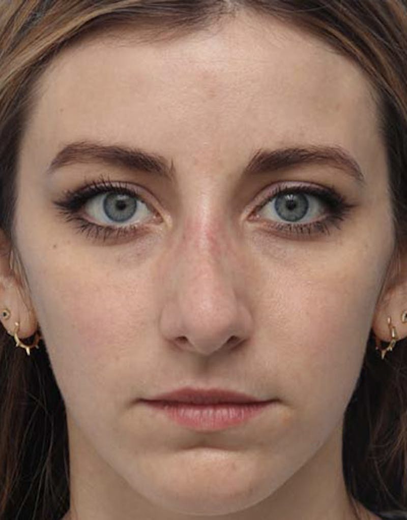 Revision Rhinoplasty Before & After Gallery - Patient 182365 - Image 3