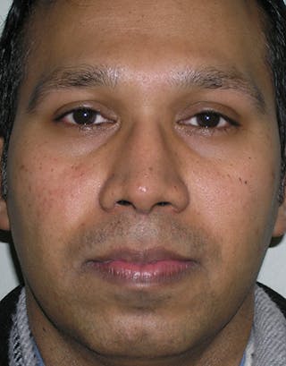 Rhinoplasty Before & After Gallery - Patient 322544 - Image 4