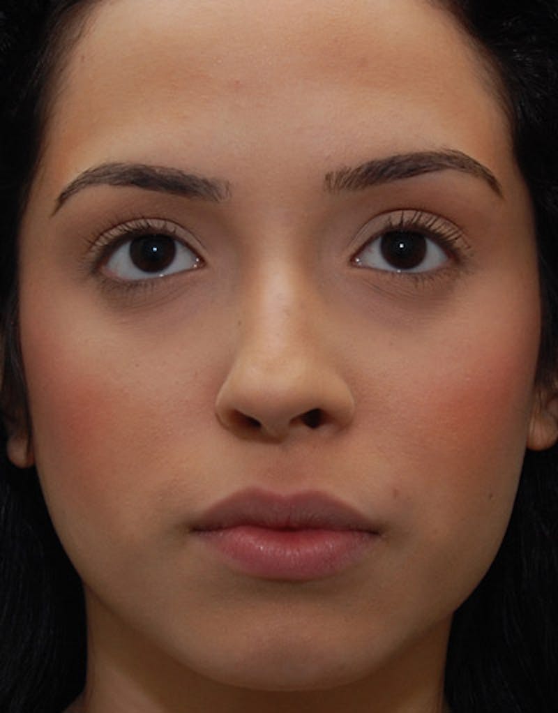 Foundation Rhinoplasty / Crooked Nose Before & After Gallery - Patient 927184 - Image 1