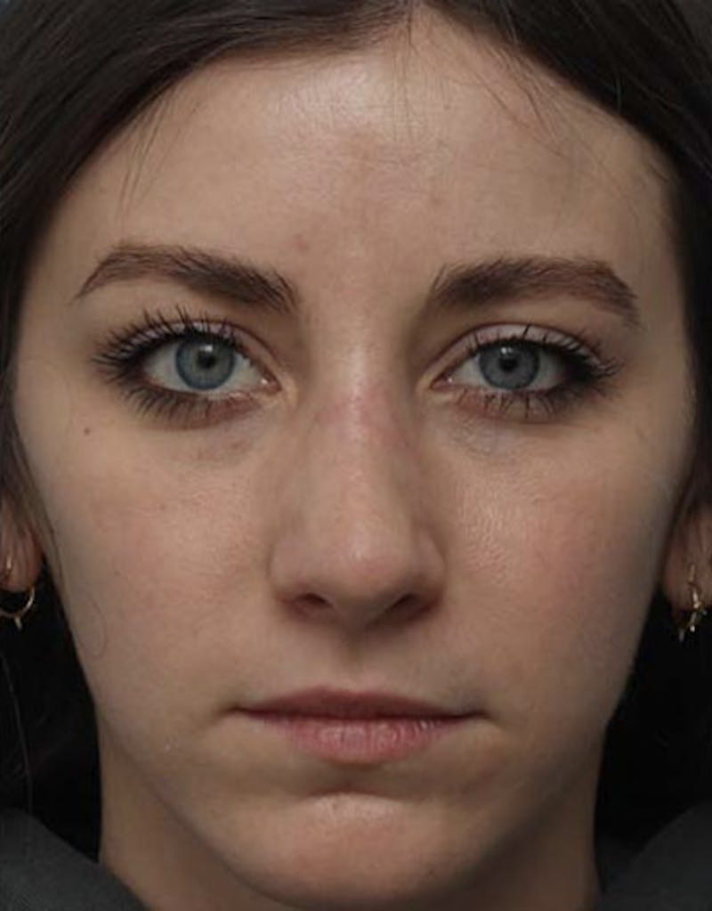 Revision Rhinoplasty Before & After Gallery - Patient 182365 - Image 4