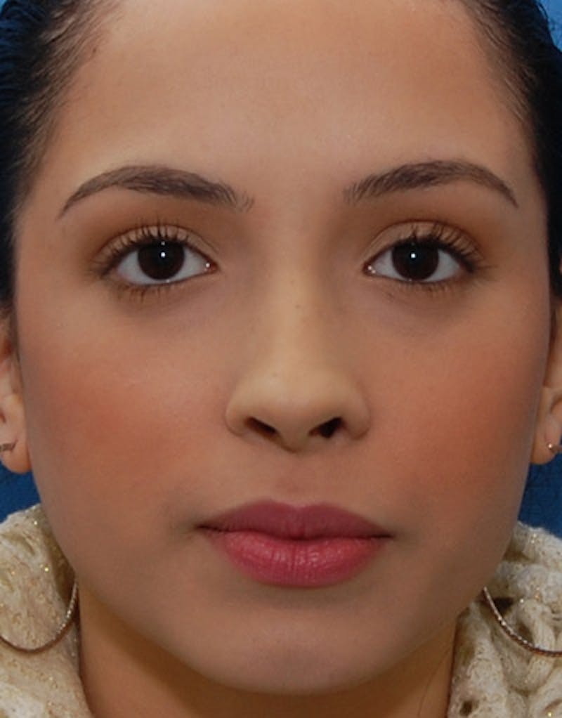 Foundation Rhinoplasty / Crooked Nose Before & After Gallery - Patient 927184 - Image 2
