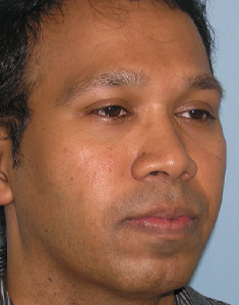Rhinoplasty  Before & After Gallery - Patient 322544 - Image 5