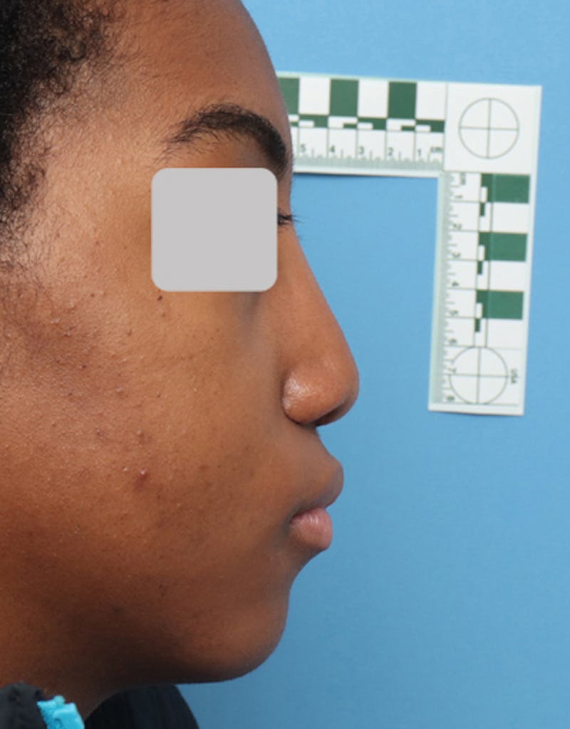 Revision Rhinoplasty Before & After Gallery - Patient 353125 - Image 1