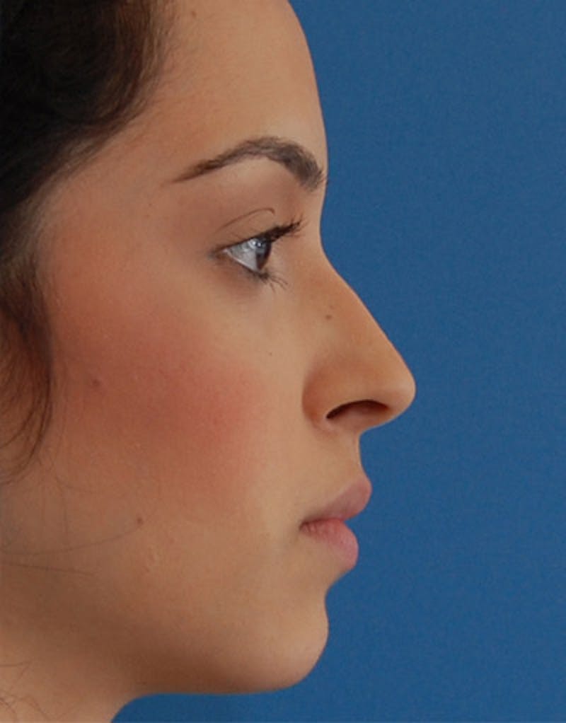 Foundation Rhinoplasty / Crooked Nose Before & After Gallery - Patient 927184 - Image 3