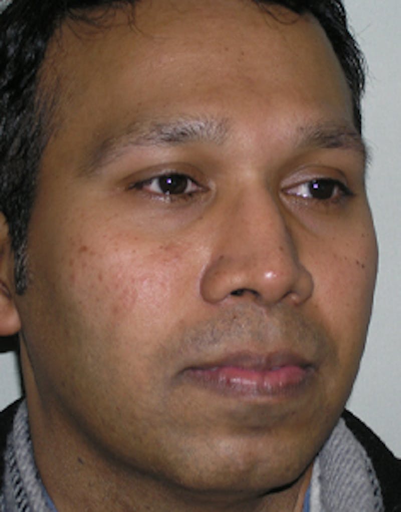 Rhinoplasty  Before & After Gallery - Patient 322544 - Image 6