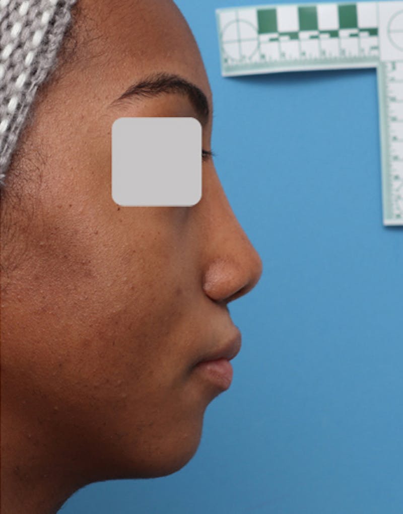 Revision Rhinoplasty Before & After Gallery - Patient 353125 - Image 2