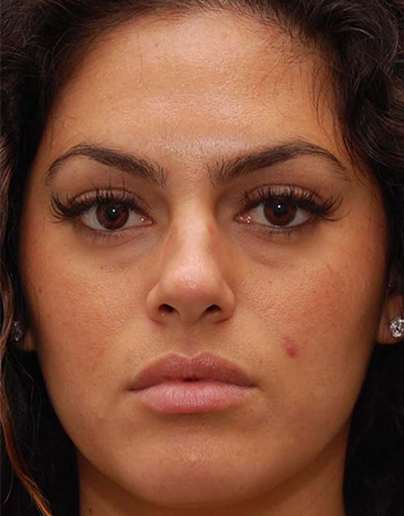 Rhinoplasty Before & After Gallery - Patient 384110 - Image 5
