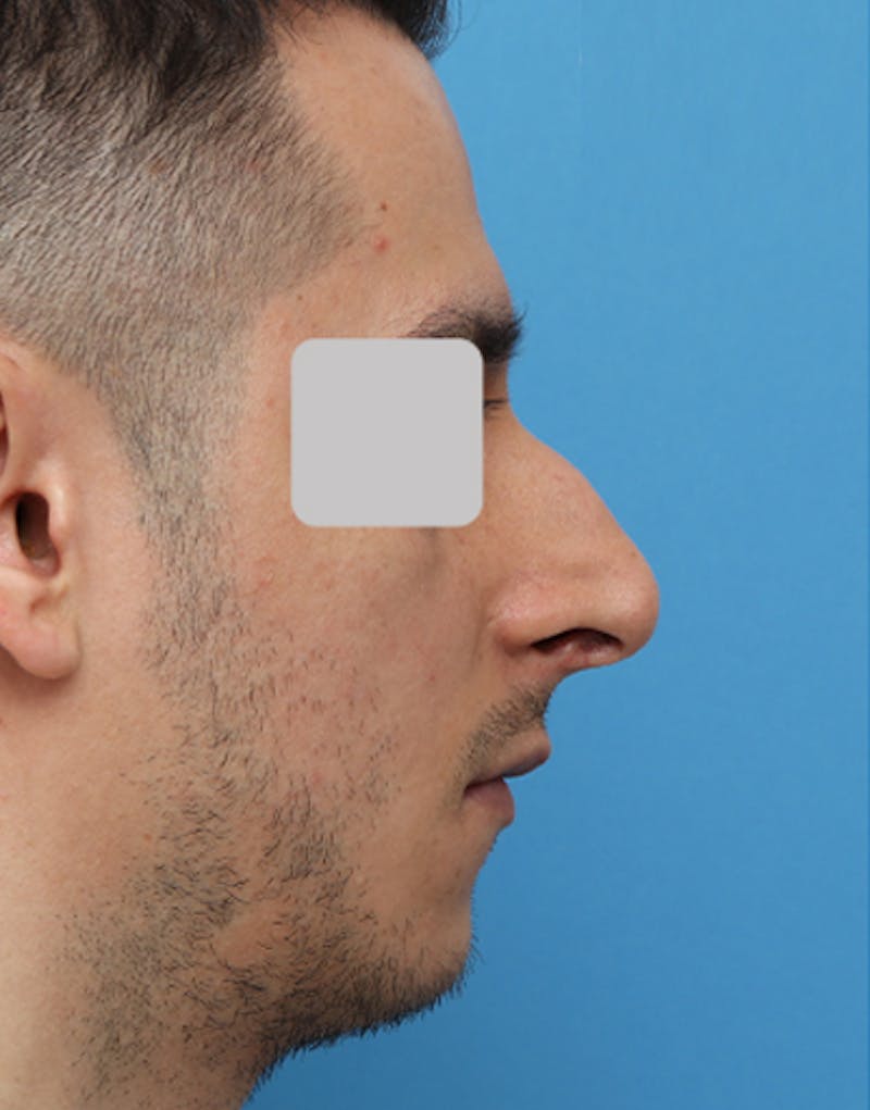 Patient Kum9ECdlSzG0FfRjK-xwKQ - Male Rhinoplasty Before & After Photos
