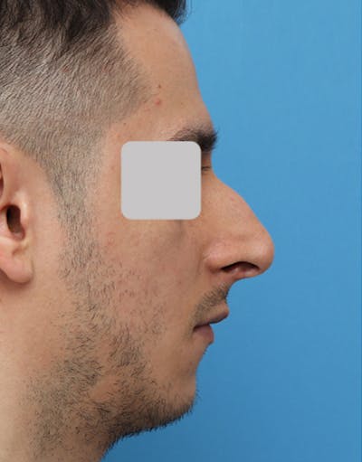 Favorite Male Rhinoplasty Before & After Gallery - Patient 363951 - Image 1