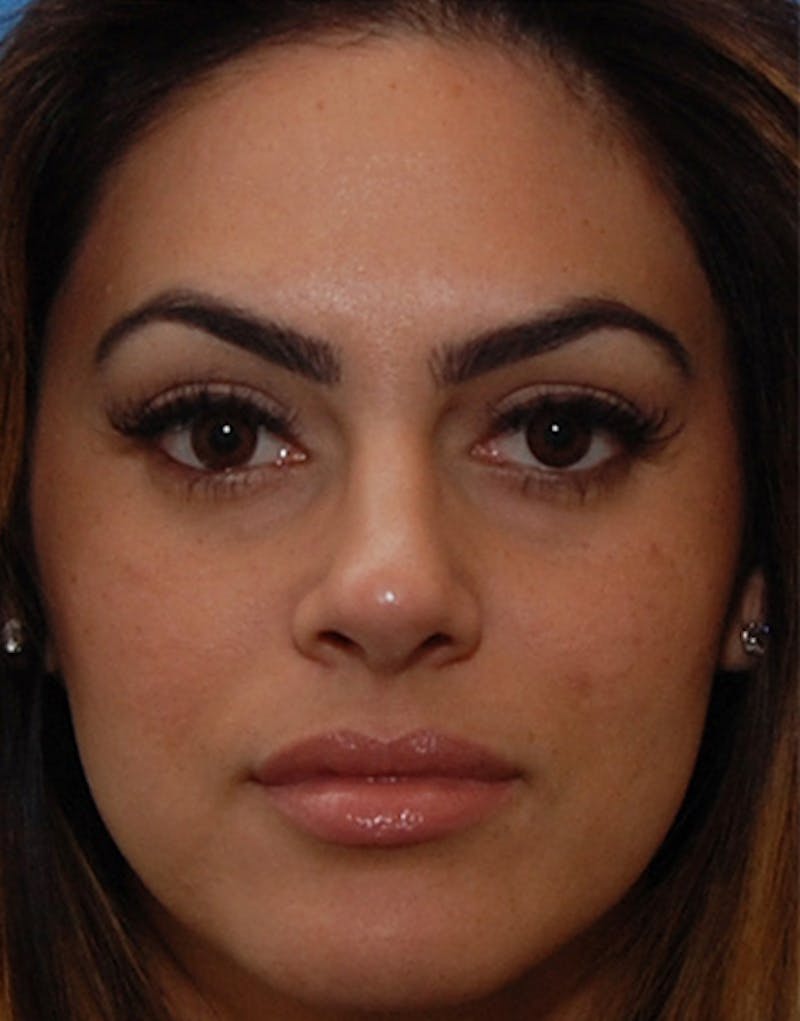 Rhinoplasty Before & After Gallery - Patient 384110 - Image 6