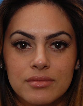 Rhinoplasty Before & After Gallery - Patient 326031 - Image 6