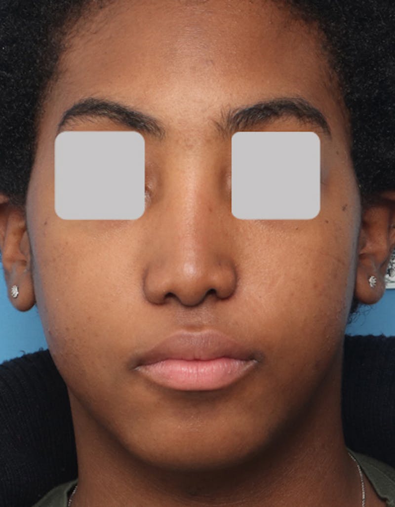 Revision Rhinoplasty Before & After Gallery - Patient 353125 - Image 3