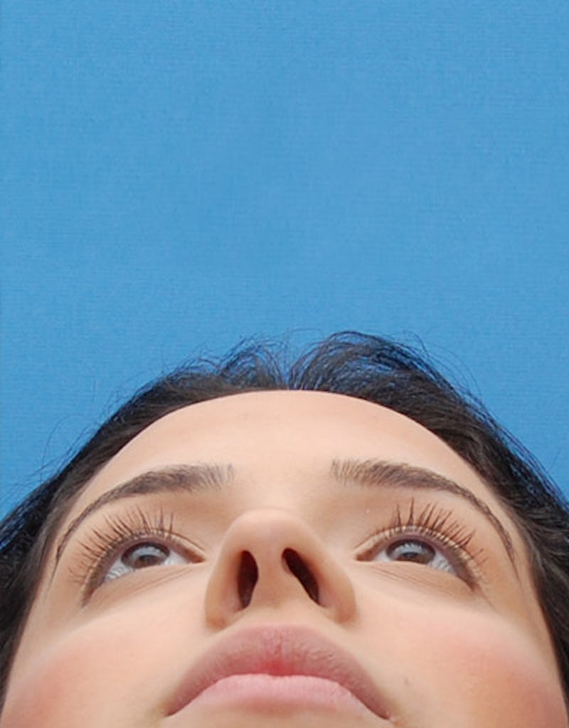 Rhinoplasty  Before & After Gallery - Patient 167723 - Image 5
