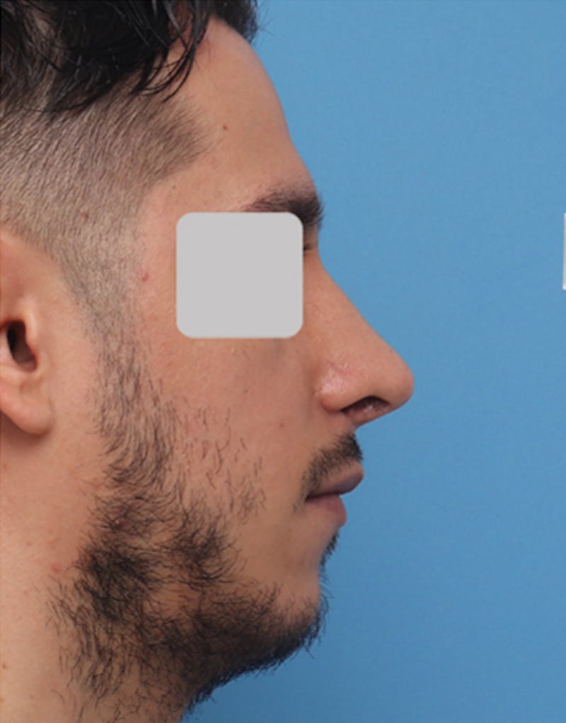 Male Rhinoplasty Before & After Gallery - Patient 251996 - Image 2
