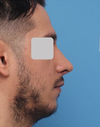 Favorite Male Rhinoplasty Before & After Gallery - Patient 363951 - Image 2