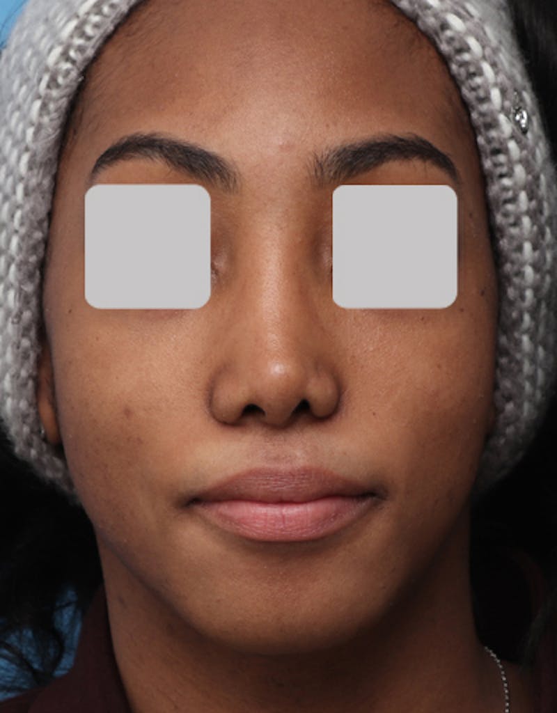 Rhinoplasty  Before & After Gallery - Patient 486299 - Image 4