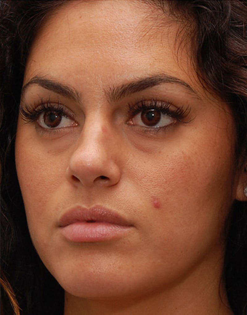 Rhinoplasty Before & After Gallery - Patient 384110 - Image 7