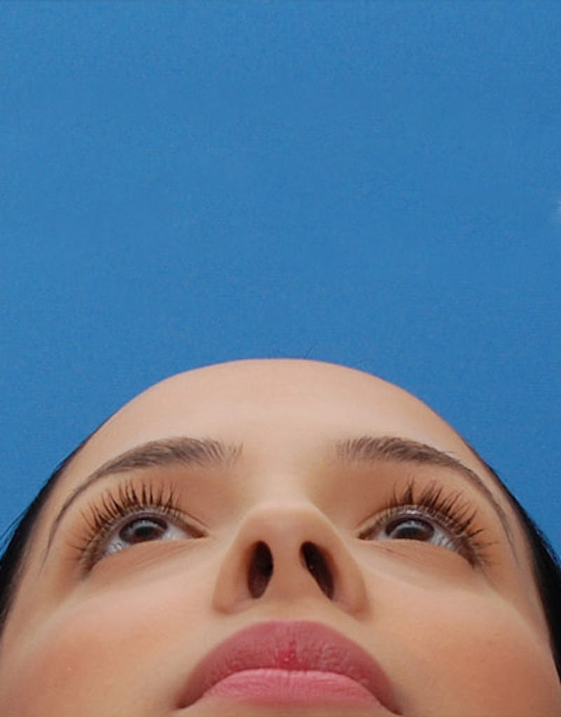 Rhinoplasty  Before & After Gallery - Patient 167723 - Image 6