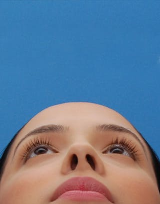 Rhinoplasty Before & After Gallery - Patient 167723 - Image 6