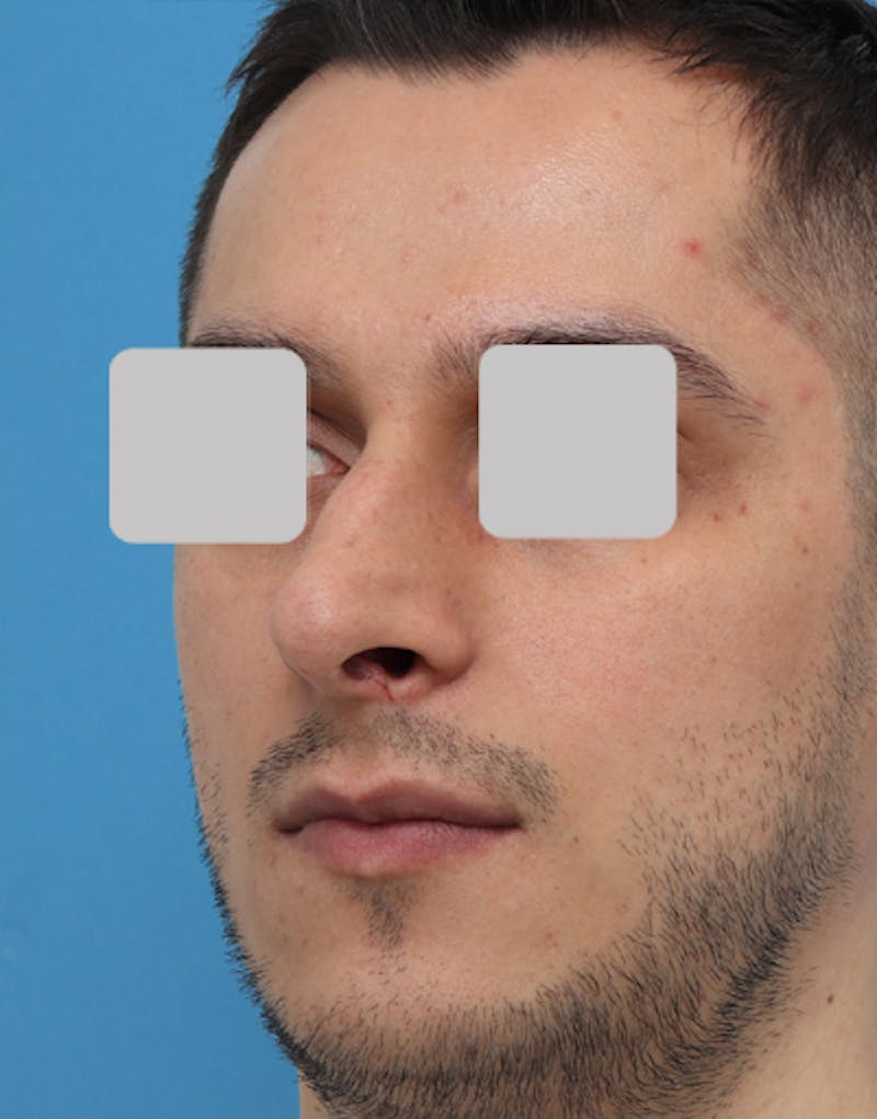 Male Rhinoplasty Before & After Gallery - Patient 251996 - Image 3