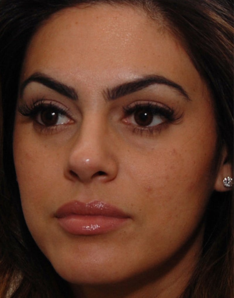 Rhinoplasty Before & After Gallery - Patient 384110 - Image 8