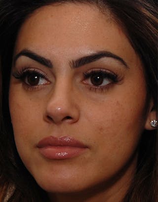 Rhinoplasty Before & After Gallery - Patient 326031 - Image 8